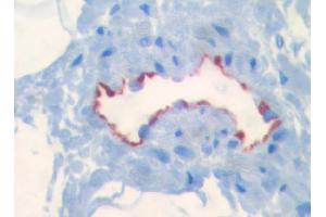 Immunohistochemical staining on paraffin sections of human intestine (border area of a colon carcinoma) using LYVE-1 antibody #ABIN115663 (picture courtesy of Dr.