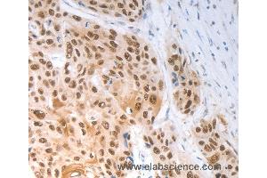 Immunohistochemistry of Human esophagus cancer using SLC22A8 Polyclonal Antibody at dilution of 1:70 (SLC22A8 抗体)