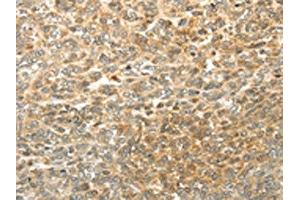 The image on the left is immunohistochemistry of paraffin-embedded Human ovarian cancer tissue using ABIN7130225(MGEA5 Antibody) at dilution 1/20, on the right is treated with fusion protein. (MGEA5 抗体)