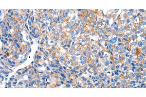Immunohistochemistry of paraffin-embedded Human breast cancer tissue using HCN2 Polyclonal Antibody at dilution 1:80 (HCN2 抗体)