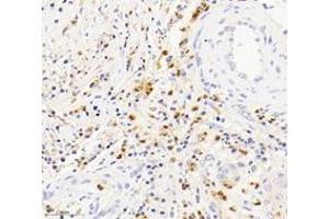 Immunohistochemistry analysis of paraffin-embedded human squamous carcinoma of the cervix using S100A12 (ABIN7075493) at dilution of 1: 4000 (S100A12 抗体)