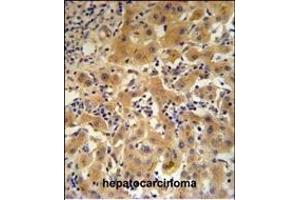 CP Antibody (N-term) (ABIN391512 and ABIN2841473) IHC analysis in formalin fixed and paraffin embedded human hepatocarcinoma followed by peroxidase conjugation of the secondary antibody and DAB staining. (Ceruloplasmin 抗体  (N-Term))