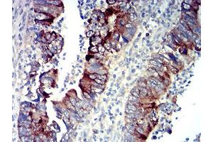 Immunohistochemical analysis of paraffin-embedded rectum cancer tissues using P2RY14 mouse mAb with DAB staining. (P2RY14 抗体)