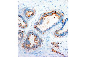 Anti-CXCR4 antibody, IHC(P) IHC(P): Human Mammary Cancer Tissue (CXCR4 抗体  (N-Term))