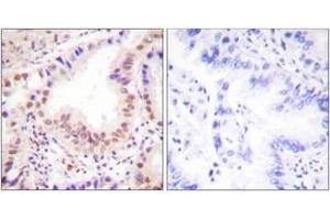 Immunohistochemistry analysis of paraffin-embedded human lung carcinoma tissue, using ETS1 (Ab-38) Antibody. (ETS1 抗体  (AA 11-60))