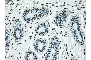 Immunohistochemical staining of paraffin-embedded breast tissue using anti-BRAF mouse monoclonal antibody. (BRAF 抗体)