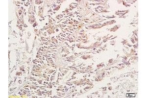 Formalin-fixed and paraffin embedded human gastric carcinoma tissue labeled with Anti-ADORA3 Adenosine A3 Receptor Polyclonal Antibody, unconjugated (ABIN673629) at 1:200, followed by incubation with conjugated secondary antibody and DAB staining (Adenosine A3 Receptor 抗体  (AA 85-180))
