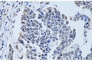Immunohistochemistry of paraffin-embedded Human lung cancer using SIN3A Polyclonal Antibody at dilution of 1:100 (40x lens). (SIN3A 抗体)