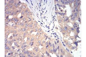 0:Immunohistochemical analysis of paraffin-embedded ovarian cancer tissues using DDX3X mouse mAb with DAB staining. (DDX3X 抗体  (AA 518-661))