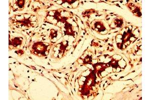 IHC image of ABIN7143738 diluted at 1:300 and staining in paraffin-embedded human breast cancer performed on a Leica BondTM system. (FUT8 抗体  (AA 247-377))