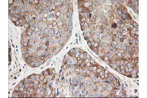 Immunohistochemical staining of paraffin-embedded Adenocarcinoma of Human breast tissue using anti-TUBB4 mouse monoclonal antibody. (TUBB4 抗体)