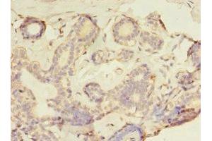 Immunohistochemistry of paraffin-embedded human breast cancer using ABIN7153932 at dilution of 1:100 (GFOD2 抗体  (AA 1-280))