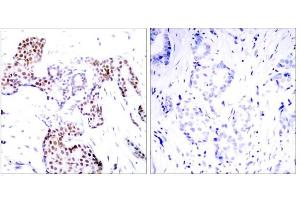 Immunohistochemical analysis of paraffin-embedded human breast carcinoma tissue using Elk-1 (phospho-Ser389) antibody (E011037). (ELK1 抗体  (pSer389))