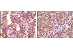 Immunohistochemical analysis of paraffin-embedded human bladder carcinoma tissue(left) and lung carcinoma tissue (right) showing cytoplasmic localization using BRAF antibody with DAB staining. (BRAF 抗体)