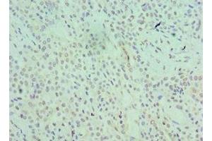 Immunohistochemistry of paraffin-embedded human breast cancer using ABIN7168966 at dilution of 1:100 (SRSF1 抗体  (AA 1-248))