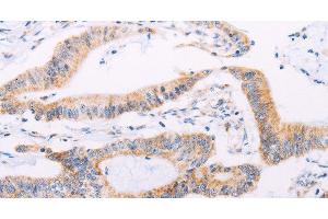 Immunohistochemistry of paraffin-embedded Human colon cancer tissue using ADAMTS16 Polyclonal Antibody at dilution 1:50