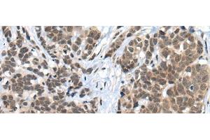 Immunohistochemistry of paraffin-embedded Human thyroid cancer tissue using ZNF83 Polyclonal Antibody at dilution of 1:50(x200) (ZNF83 抗体)