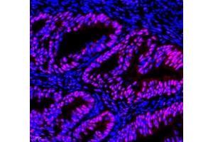 Immunofluorescence of paraffin embedded human ovarian cancer using EFTUD2 (ABIN7073810) at dilution of 1: 2400 (400x lens) (EFTUD2 抗体)
