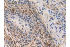 Detection of S100A2 in Human Skin cancer Tissue using Polyclonal Antibody to S100 Calcium Binding Protein A2 (S100A2) (S100A2 抗体  (AA 2-98))