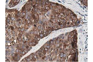 Immunohistochemical staining of paraffin-embedded Adenocarcinoma of Human breast tissue using anti-OSBP mouse monoclonal antibody. (OSBP 抗体)