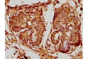 IHC image of ABIN7164990 diluted at 1:100 and staining in paraffin-embedded human breast cancer performed on a Leica BondTM system. (PSMB8 抗体  (AA 176-276))