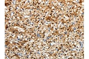 The image on the left is immunohistochemistry of paraffin-embedded Human renal cancer tissue using ABIN7190724(FZD2 Antibody) at dilution 1/25, on the right is treated with synthetic peptide. (FZD2 抗体)