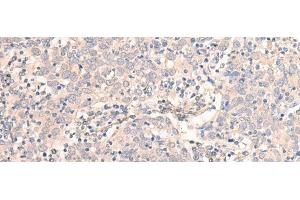 Immunohistochemistry of paraffin-embedded Human cervical cancer tissue using EMX1 Polyclonal Antibody at dilution of 1:25(x200) (EMX1 抗体)
