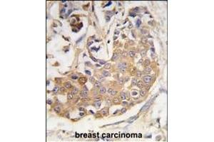 Formalin-fixed and paraffin-embedded human breast carcinoma tissue reacted with COL9A1 antibody (Center) (ABIN389244 and ABIN2839390) , which was peroxidase-conjugated to the secondary antibody, followed by DAB staining.