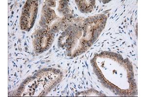 Immunohistochemical staining of paraffin-embedded Adenocarcinoma of Human colon tissue using anti-NXNL2 mouse monoclonal antibody. (NXNL2 抗体)