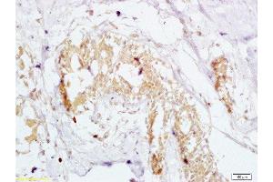 Formalin-fixed and human breast carcinoma tissue labeled with Anti-GTPBP10 Polyclonal Antibody , Unconjugated at 1:200 followed by conjugation to the secondary antibody and DAB staining (GTPBP10 抗体  (AA 151-250))