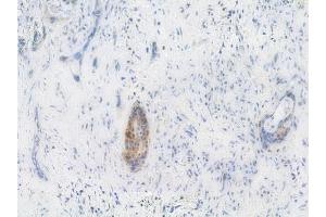 ABIN6256686 and ABIN6267254 at 1/100 staining human pancreatic carcinoma by IHC-P.