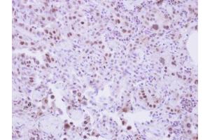 IHC-P Image Immunohistochemical analysis of paraffin-embedded human lung adenocarcinoma, using SLU7, antibody at 1:250 dilution. (SLU7 抗体  (C-Term))