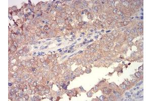 Immunohistochemical analysis of paraffin-embedded endometrial cancer tissues using WNT3A mouse mAb with DAB staining.