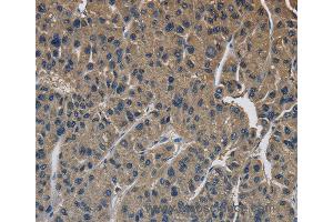 Immunohistochemistry of Human liver cancer using SIGMAR1 Polyclonal Antibody at dilution of 1:50 (SIGMAR1 抗体)