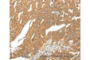 Immunohistochemistry of Human ovarian cancer using SKP1 Polyclonal Antibody at dilution of 1:30 (SKP1 抗体)