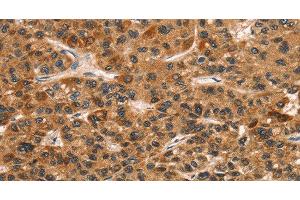 Immunohistochemistry of paraffin-embedded Human liver cancer tissue using CD159a/c Polyclonal Antibody at dilution 1:30 (CD159a/c 抗体)