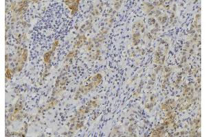 ABIN6273508 at 1/100 staining Human lung cancer tissue by IHC-P. (GZMK 抗体  (Internal Region))