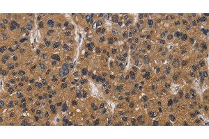 Immunohistochemistry of paraffin-embedded Human liver cancer tissue using E2F4 Polyclonal Antibody at dilution 1:40 (E2F4 抗体)