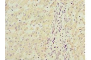 Immunohistochemistry of paraffin-embedded human liver cancer using ABIN7160192 at dilution of 1:100 (MGLL 抗体  (AA 1-303))