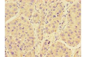 Immunohistochemistry of paraffin-embedded human liver cancer using ABIN7167280 at dilution of 1:100 (RAB28 抗体  (AA 98-218))