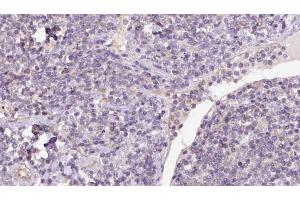 ABIN6273174 at 1/100 staining Human lymph cancer tissue by IHC-P. (Syntaxin 16 抗体  (N-Term))