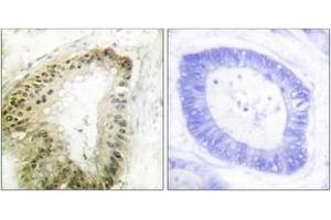 Immunohistochemistry analysis of paraffin-embedded human colon carcinoma, using LKB1 (Phospho-Ser428) Antibody. (LKB1 抗体  (pSer428))