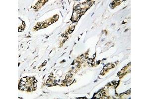 IHC-P: HSP105 antibody testing of human breast cancer tissue (HSPH1 抗体  (AA 713-733))