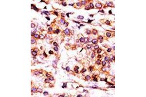 Formalin-fixed and paraffin-embedded human cancer tissue reacted with the primary antibody, which was peroxidase-conjugated to the secondary antibody, followed by AEC staining (PANK1 抗体  (Middle Region))