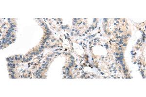 Immunohistochemistry of paraffin-embedded Human thyroid cancer using TBXA2R Polyclonal Antibody at dilution of 1/40 (TBXA2R 抗体)