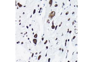 Immunohistochemistry of paraffin-embedded human liver cancer using Phospho-c-Jun-T91 Rabbit pAb (ABIN7268058) at dilution of 1:50 (40x lens). (C-JUN 抗体  (pThr91))