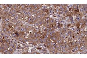 ABIN6273850 at 1/100 staining Human liver cancer tissue by IHC-P. (G Protein-Coupled Receptor 1 抗体  (C-Term))