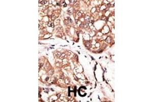 Formalin-fixed and paraffin-embedded human cancer tissue reacted with the primary antibody, which was peroxidase-conjugated to the secondary antibody, followed by AEC staining. (ATG4D 抗体  (AA 220-249))