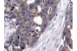 Immunohistochemistry analyzes of p70 S6K antibody in paraffin-embedded human breast carcinoma tissue. (RPS6KB1 抗体)