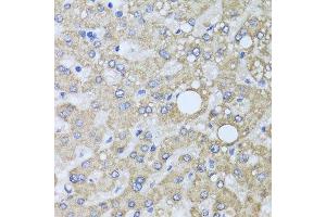 Immunohistochemistry of paraffin-embedded human liver injury using AARS2 antibody at dilution of 1:100 (x40 lens). (AARS2 抗体)